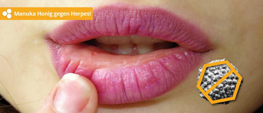 Manuka Hongi gegen Herpes-Bläschen auf den Lippen.